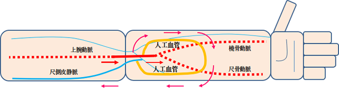 シャント手術画像