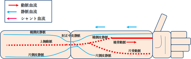 シャント手術画像