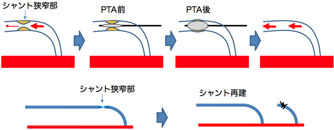 シャント手術画像