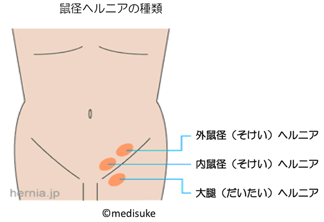 鼠径ヘルニア