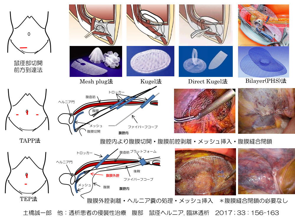 鼠径ヘルニア