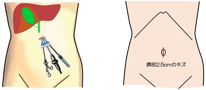 単孔式腹腔鏡下手術