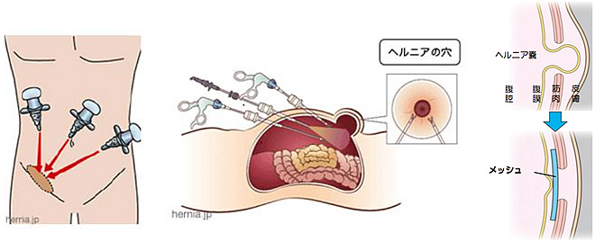 腹腔鏡下鼠経ヘルニア根治術