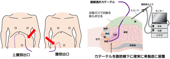 腹腔鏡腹膜透析用カテーテル挿入