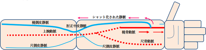 シャント手術画像